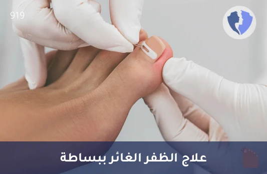 علاج ظفر القدم الغائر - عملية استئصال ظفر غائر تحت التخدير الموضعي