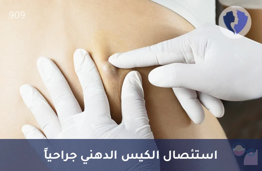 استئصال الكيس الدهني - عملية استئصال كيس دهني تحت التخدير العام