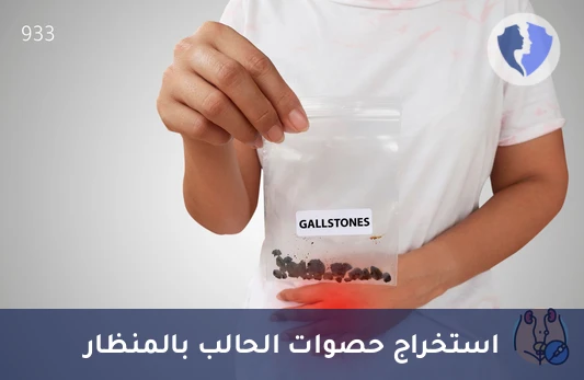 استخراج حصوات الحالب بالمنظار - عملية منظار الحالب لاستخراج الحصوات