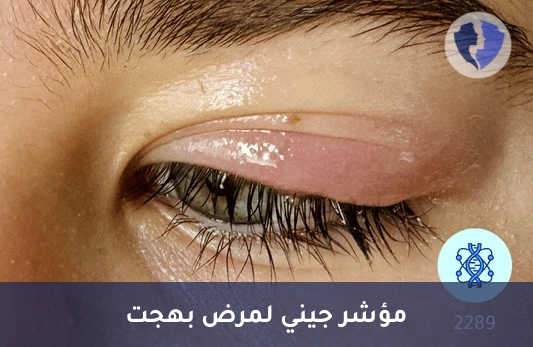 فحص جين مرض بهجت - فحص الجين المرتبط بمرض بهجت (HLA-B51)