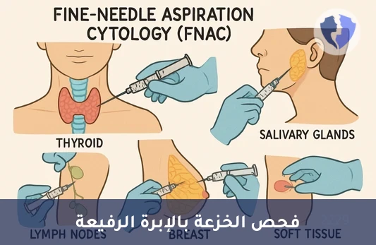خزعة الإبرة الدقيقة التشخيصية - فحص الخزعة بالإبرة الرفيعة (FNAC)