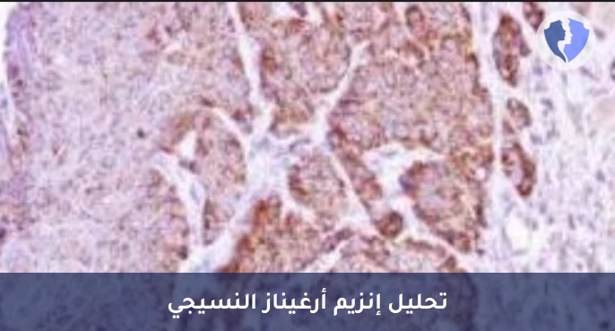 فحص Arginase-1 لسرطان الكبد - فحص الكيمياء النسيجية المناعية لإنزيم أرغيناز-1 (Arginase-1)