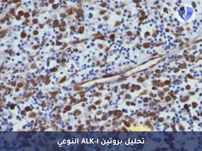 تحليل بروتين ALK-1 للأورام - فحص الكيمياء النسيجية المناعية لبروتين (ALK-1)