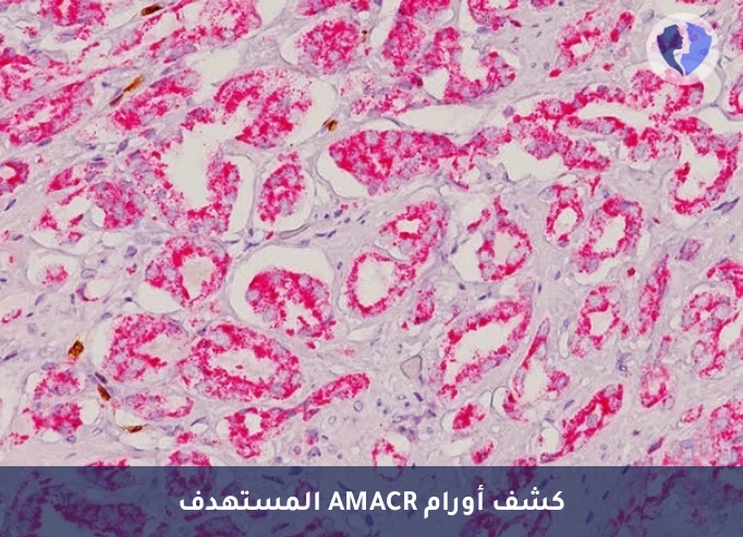 فحص AMACR لسرطان البروستاتا - فحص الكيمياء النسيجية المناعية لبروتين AMACR (P504S)