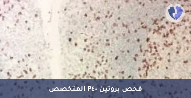 فحص P40 لتشخيص سرطان الرئة - فحص الكيمياء النسيجية المناعية لبروتين P40