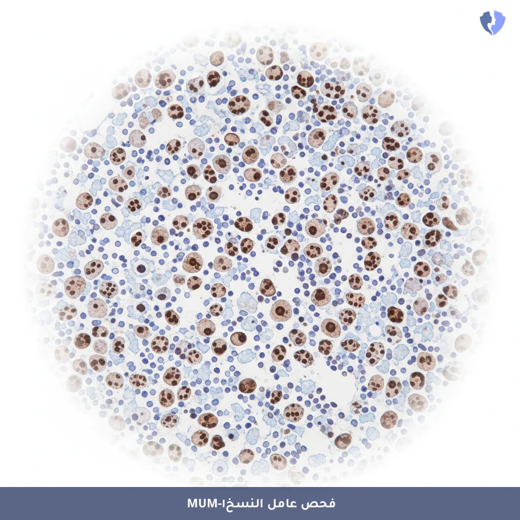 فحص تصنيف سرطان الغدد اللمفاوية - فحص بروتين MUM-1 الكيميائي النسيجي المناعي (MUM-1)