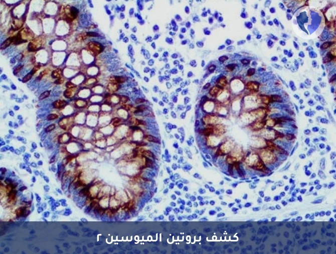 فحص أورام القولون والمبيض المخاطية - فحص بروتين الميوسين 2 الكيميائي النسيجي المناعي (MUC2)