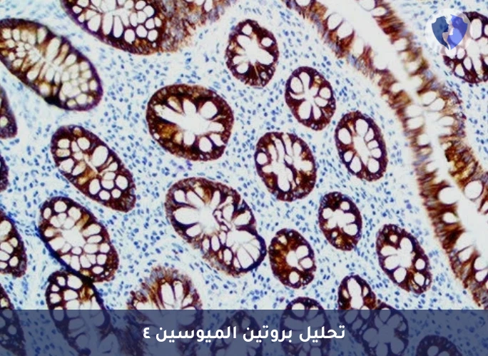 فحص تشخيص الأورام النادرة والعدوانية - فحص بروتين الميوسين 4 الكيميائي النسيجي المناعي (MUC4)