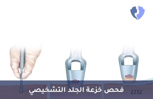 فحص خزعة الجلد التشخيصي - فحص خزعة من الجلد (Skin Biopsy)