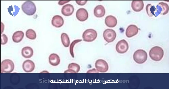 فحص فقر الدم المنجلي - فحص خلايا الدم المنجلية (Sickle Cell Screen)