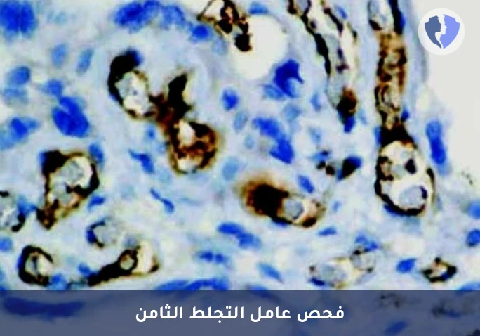 فحص العامل الثامن لأورام الأوعية - فحص كيميائي نسيجي مناعي للعامل الثامن (Factor VIII)