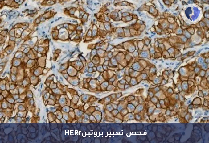 فحص مستقبلات سرطان الثدي والمعدة - فحص مستقبل HER2 الكيميائي النسيجي المناعي (HER2)