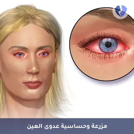 مزرعة عين لتشخيص الالتهاب - مسحة ومزرعة وحساسية العين